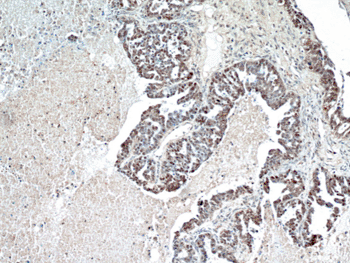 Image: Immunohistochemistry of paraffin-embedded human ovary tumor using P53 antibody (Photo courtesy of Proteintech).